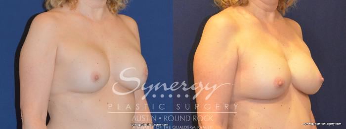 Before & After Revision Breast Augmentation Case 326 View #3 View in Austin, TX