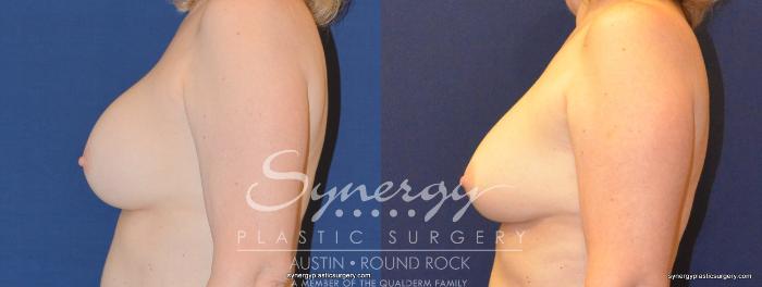 Before & After Revision Breast Augmentation Case 326 View #4 View in Austin, TX
