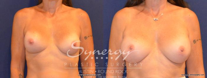 Before & After Revision Breast Augmentation Case 339 View #1 View in Austin, TX
