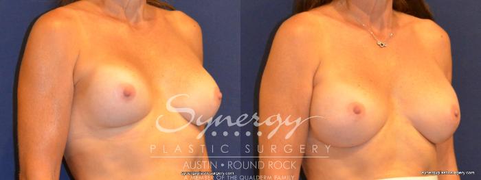 Before & After Revision Breast Augmentation Case 339 View #3 View in Austin, TX