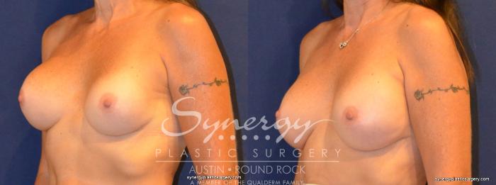 Before & After Revision Breast Augmentation Case 339 View #5 View in Austin, TX