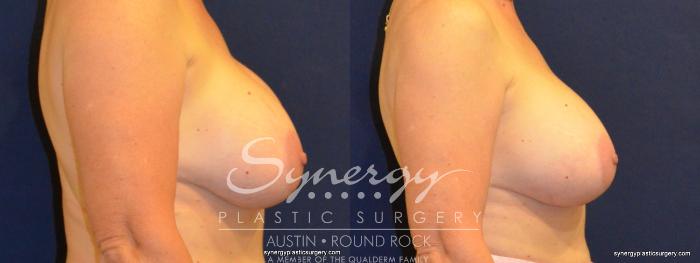 Before & After Revision Breast Augmentation Case 369 View #2 View in Austin, TX