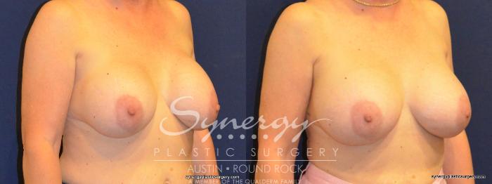 Before & After Revision Breast Augmentation Case 369 View #3 View in Austin, TX