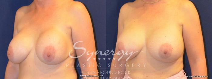 Before & After Revision Breast Augmentation Case 369 View #4 View in Austin, TX