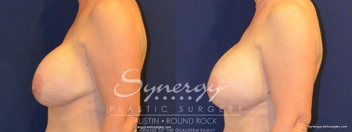 Before & After Revision Breast Augmentation Case 369 View #5 View in Austin, TX