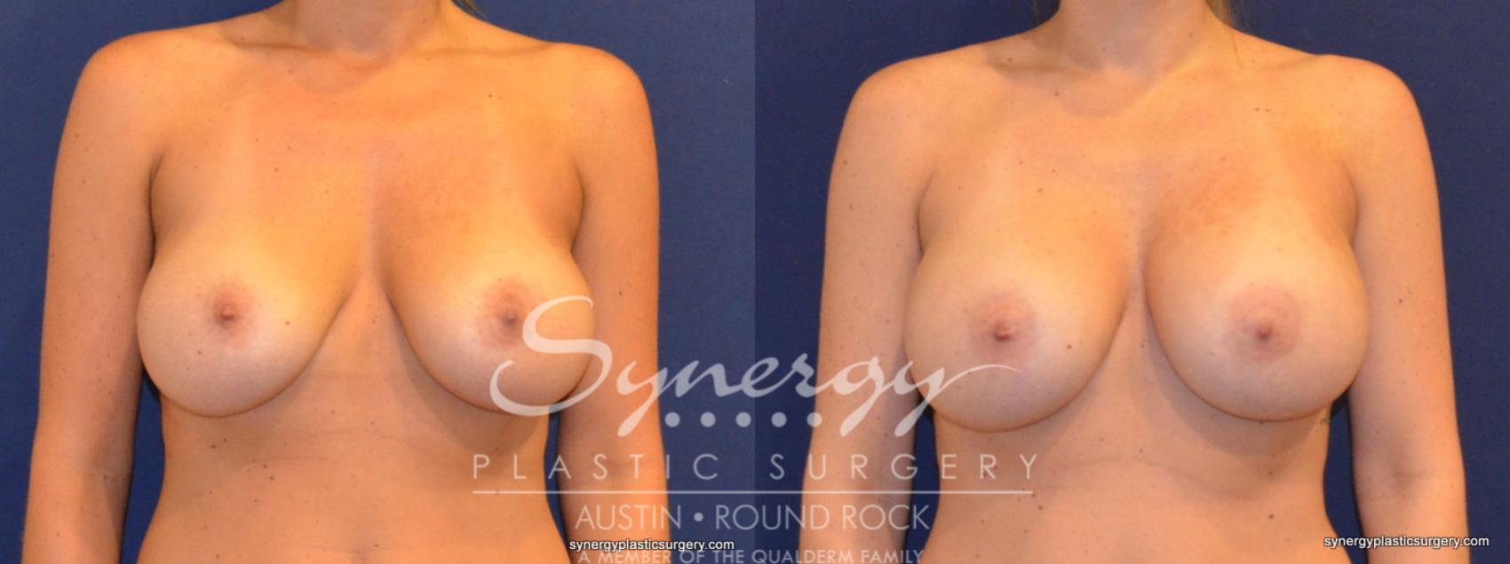 Before & After Revision Breast Augmentation Case 376 View #1 View in Austin, TX