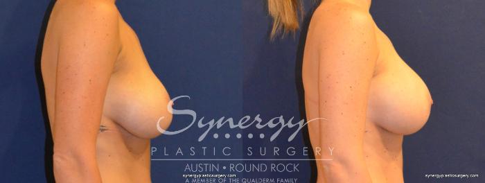 Before & After Revision Breast Augmentation Case 376 View #2 View in Austin, TX
