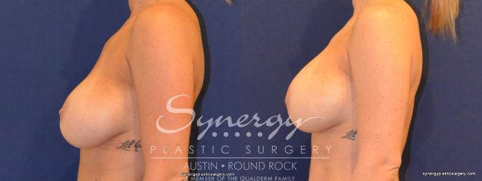 Before & After Revision Breast Augmentation Case 376 View #4 View in Austin, TX