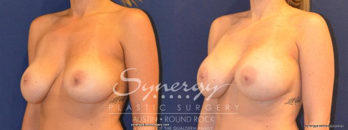 Before & After Revision Breast Augmentation Case 376 View #5 View in Austin, TX