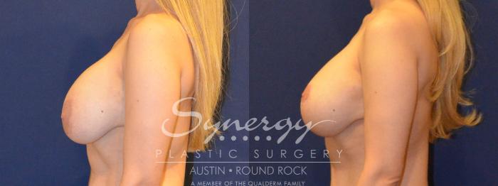 Before & After Revision Breast Augmentation Case 385 View #3 View in Austin, TX