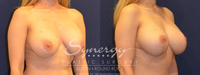 Before & After Revision Breast Augmentation Case 385 View #5 View in Austin, TX