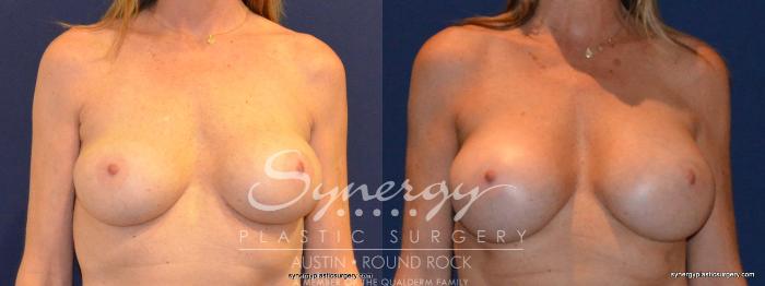 Before & After Revision Breast Augmentation Case 401 View #1 View in Austin, TX