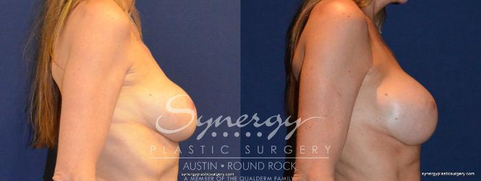 Before & After Revision Breast Augmentation Case 401 View #2 View in Austin, TX