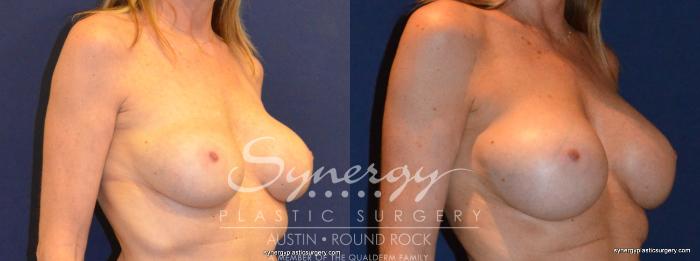 Before & After Revision Breast Augmentation Case 401 View #3 View in Austin, TX