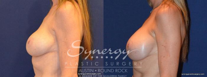Before & After Revision Breast Augmentation Case 401 View #4 View in Austin, TX