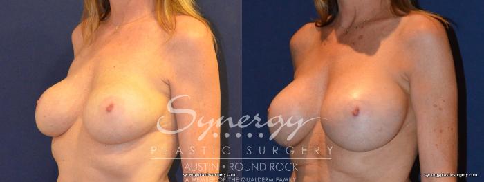 Before & After Revision Breast Augmentation Case 401 View #5 View in Austin, TX