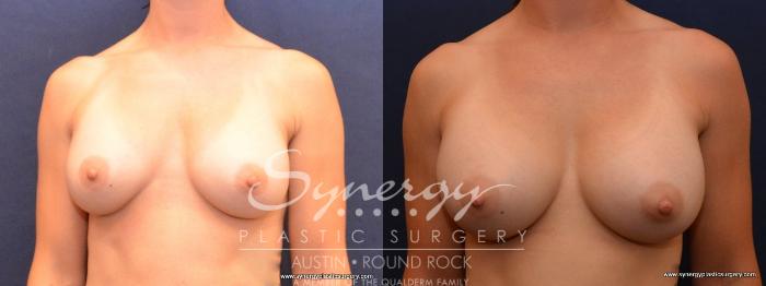 Before & After Revision Breast Augmentation Case 447 View #1 View in Austin, TX