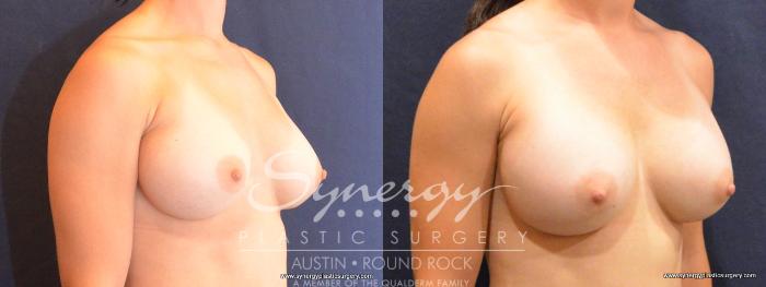Before & After Revision Breast Augmentation Case 447 View #3 View in Austin, TX
