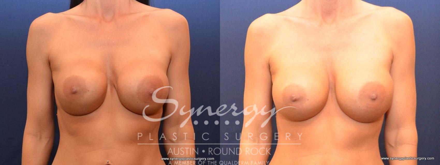 Before & After Revision Breast Augmentation Case 479 View #1 View in Austin, TX