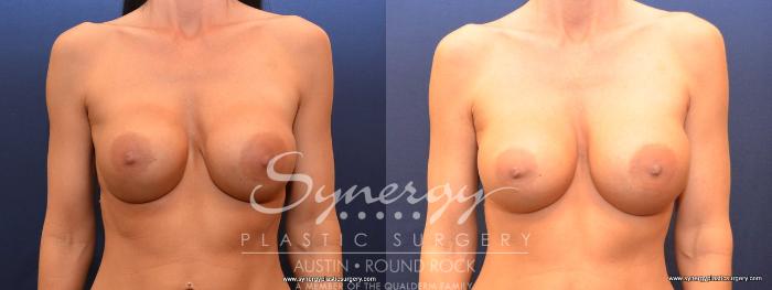 Before & After Revision Breast Augmentation Case 479 View #1 View in Austin, TX