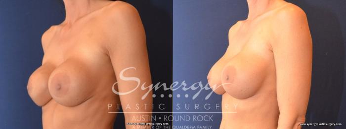 Before & After Revision Breast Augmentation Case 479 View #2 View in Austin, TX
