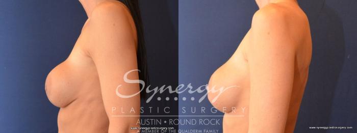 Before & After Revision Breast Augmentation Case 479 View #3 View in Austin, TX