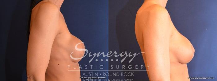 Before & After Revision Breast Augmentation Case 479 View #4 View in Austin, TX