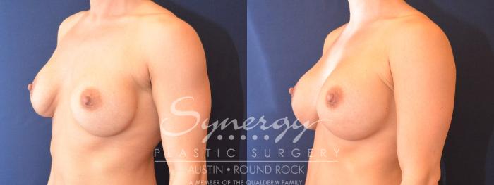 Before & After Revision Breast Augmentation Case 482 View #2 View in Austin, TX