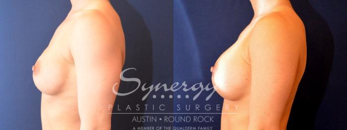 Before & After Revision Breast Augmentation Case 482 View #3 View in Austin, TX