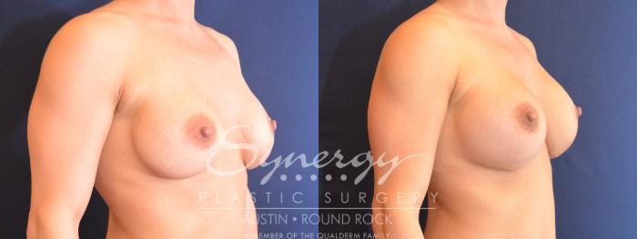 Before & After Revision Breast Augmentation Case 482 View #4 View in Austin, TX