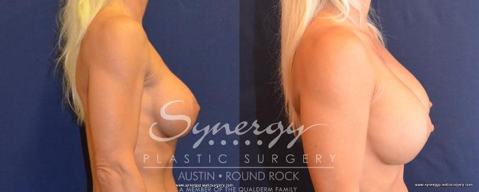 Before & After Revision Breast Augmentation Case 493 View #2 View in Austin, TX