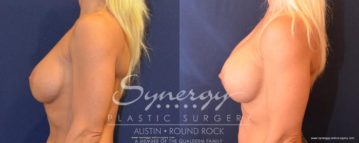 Before & After Revision Breast Augmentation Case 493 View #3 View in Austin, TX