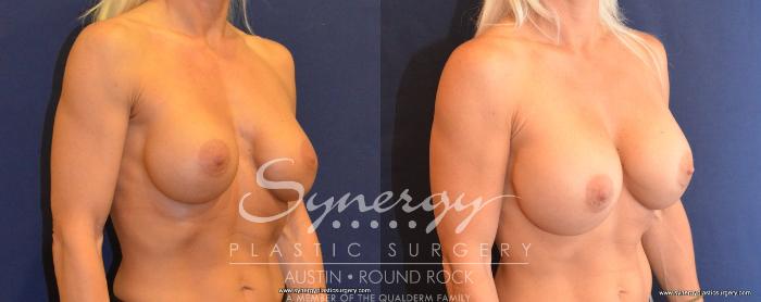 Before & After Revision Breast Augmentation Case 493 View #4 View in Austin, TX