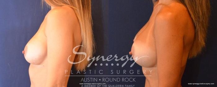 Before & After Revision Breast Augmentation Case 495 View #3 View in Austin, TX