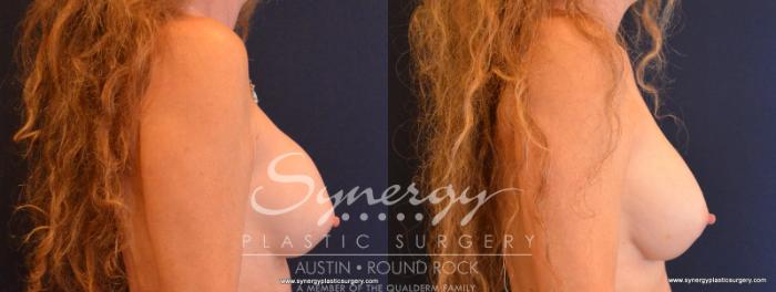 Before & After Revision Breast Augmentation Case 558 View #5 View in Austin, TX