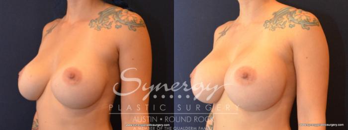 Before & After Revision Breast Augmentation Case 565 View #2 View in Austin, TX