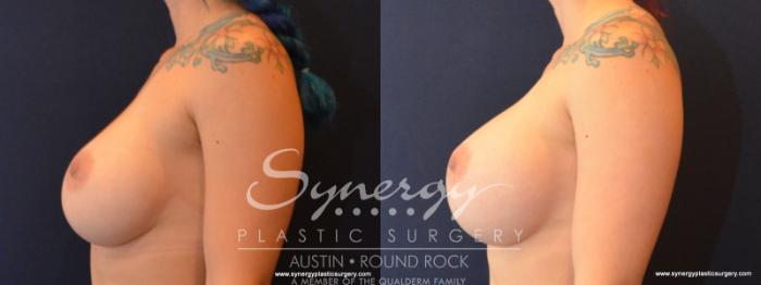 Before & After Revision Breast Augmentation Case 565 View #3 View in Austin, TX