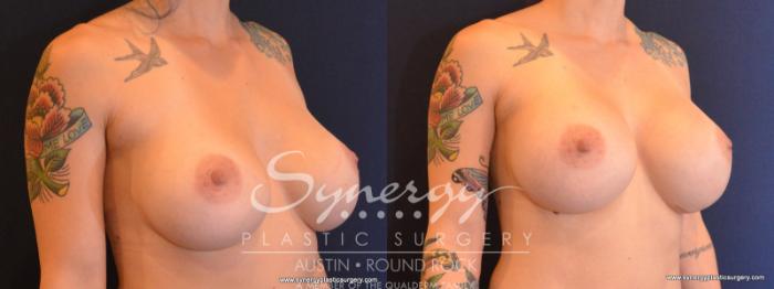 Before & After Revision Breast Augmentation Case 565 View #4 View in Austin, TX