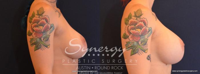 Before & After Revision Breast Augmentation Case 565 View #5 View in Austin, TX