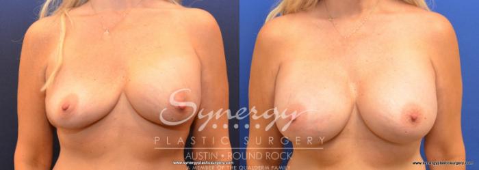 Before & After Revision Breast Augmentation Case 577 View #1 View in Austin, TX