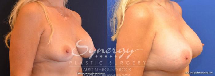 Before & After Revision Breast Augmentation Case 577 View #2 View in Austin, TX