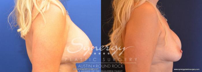 Before & After Revision Breast Augmentation Case 577 View #3 View in Austin, TX