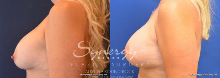 Before & After Revision Breast Augmentation Case 577 View #4 View in Austin, TX
