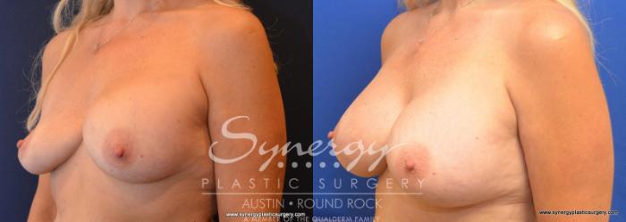 Before & After Revision Breast Augmentation Case 577 View #5 View in Austin, TX