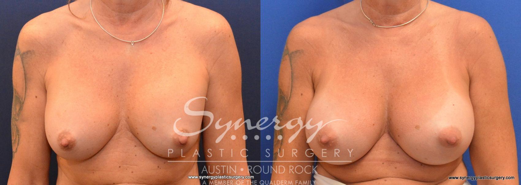 Before & After Revision Breast Augmentation Case 592 View #1 View in Austin, TX