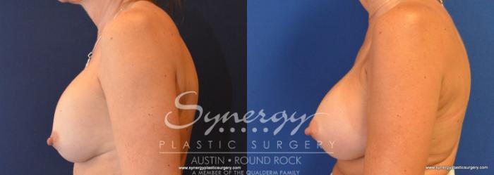 Before & After Revision Breast Augmentation Case 592 View #2 View in Austin, TX