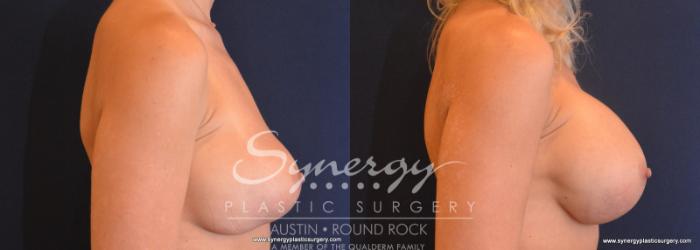 Before & After Revision Breast Augmentation Case 610 View #2 View in Austin, TX