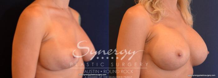 Before & After Revision Breast Augmentation Case 610 View #3 View in Austin, TX