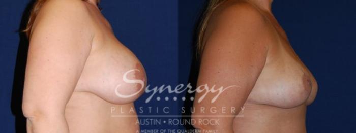 Before & After Revision Breast Augmentation Case 62 View #1 View in Austin, TX