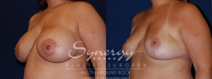 Before & After Revision Breast Augmentation Case 62 View #2 View in Austin, TX